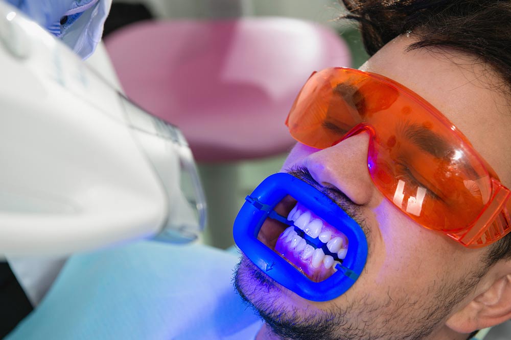 Top 5 Different Teeth Whitening Procedures